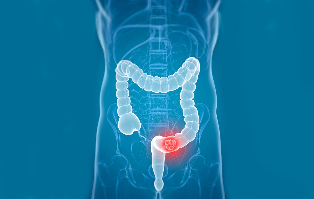 Colorectal Cancer – What it is, how it is diagnosed and treated and the important risk factors. - featured image